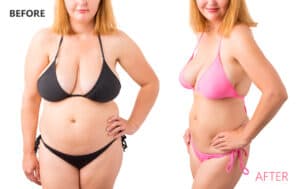 Semaglutide - Before And After Results